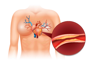 4 Gejala yang Terlihat pada Penderita Dislipidemia